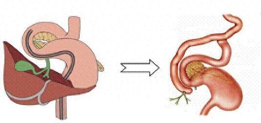 因解剖結構發生改變,腔道更為彎曲,且可能伴有不同程度的腸管粘連成角