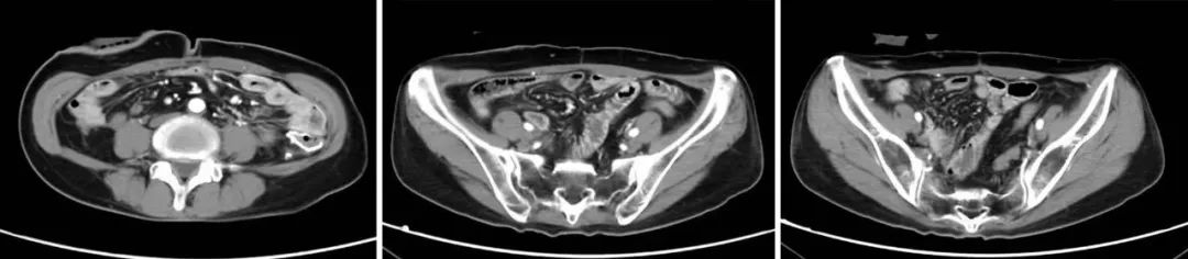怎么用医疗灌注细胞减灭术+腹腔热灌注化疗  综合治疗让腹膜癌不再是“不治之症”_https://www.jmylbn.com_新闻资讯_第3张