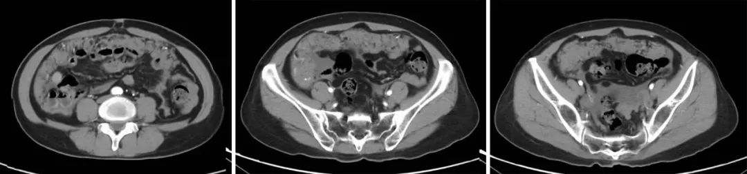 怎么用医疗灌注细胞减灭术+腹腔热灌注化疗  综合治疗让腹膜癌不再是“不治之症”_https://www.jmylbn.com_新闻资讯_第2张