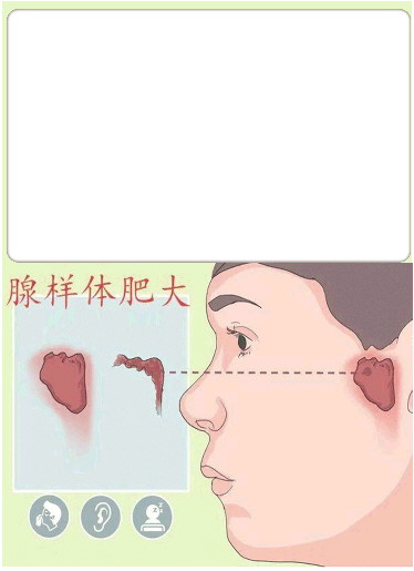 腺样体肥大成儿童"颜值杀手"|手术_新浪财经_新浪网