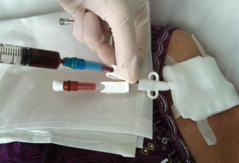 4个问题,带您了解中心静脉导管冲管及封管的要点