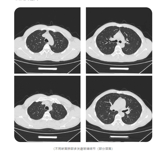 37岁的他,557个肺结节!|肺部_新浪财经_新浪网