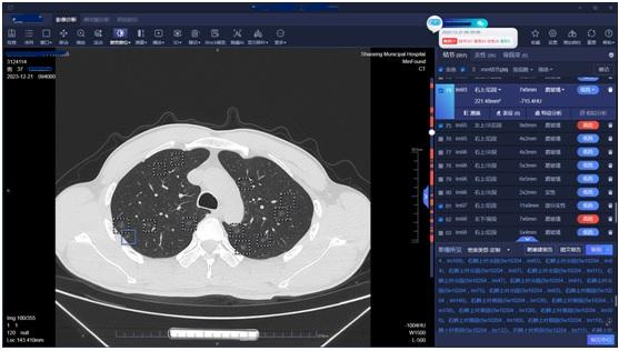 (肺结节人工智能筛查影像)