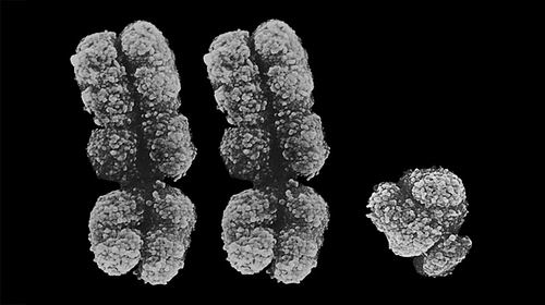 古DNA揭示性染色体综合征最早病例