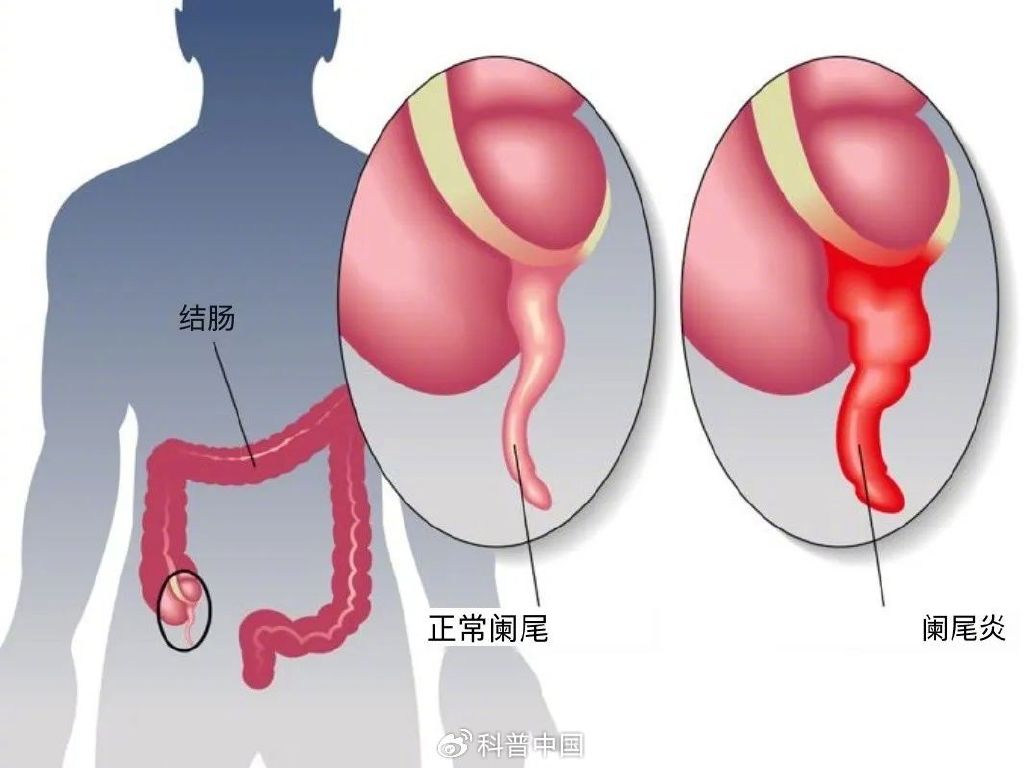 阑尾癌_新浪财经_新浪网