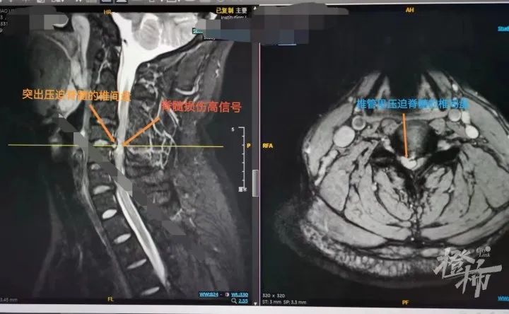 核磁共振结果显示,张先生已经出现了脊髓损伤!