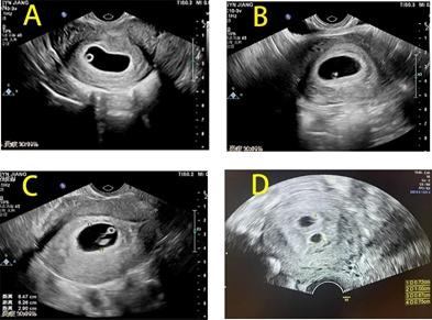 图1 四位怀孕困难女性早孕超声截图