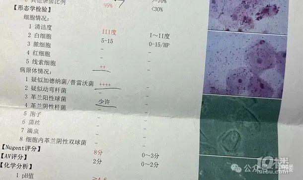 可一周后,该女生发现白带呈豆腐渣状,并伴有异味,私处还有瘙痒灼烧感
