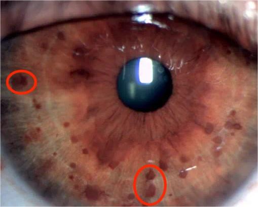 神经纤维瘤1型患儿迎来好消息!