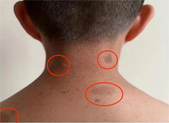 神经纤维瘤1型患儿迎来好消息!