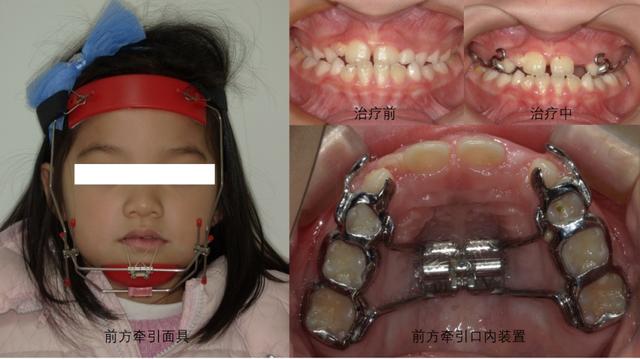 小小"兜齿"不害怕,早期矫正降服它_新浪财经_新浪网
