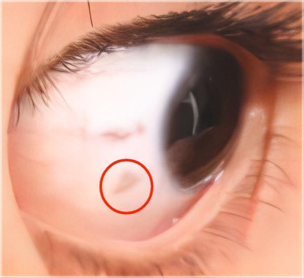 虹膜错构瘤(lisch结节):这是一