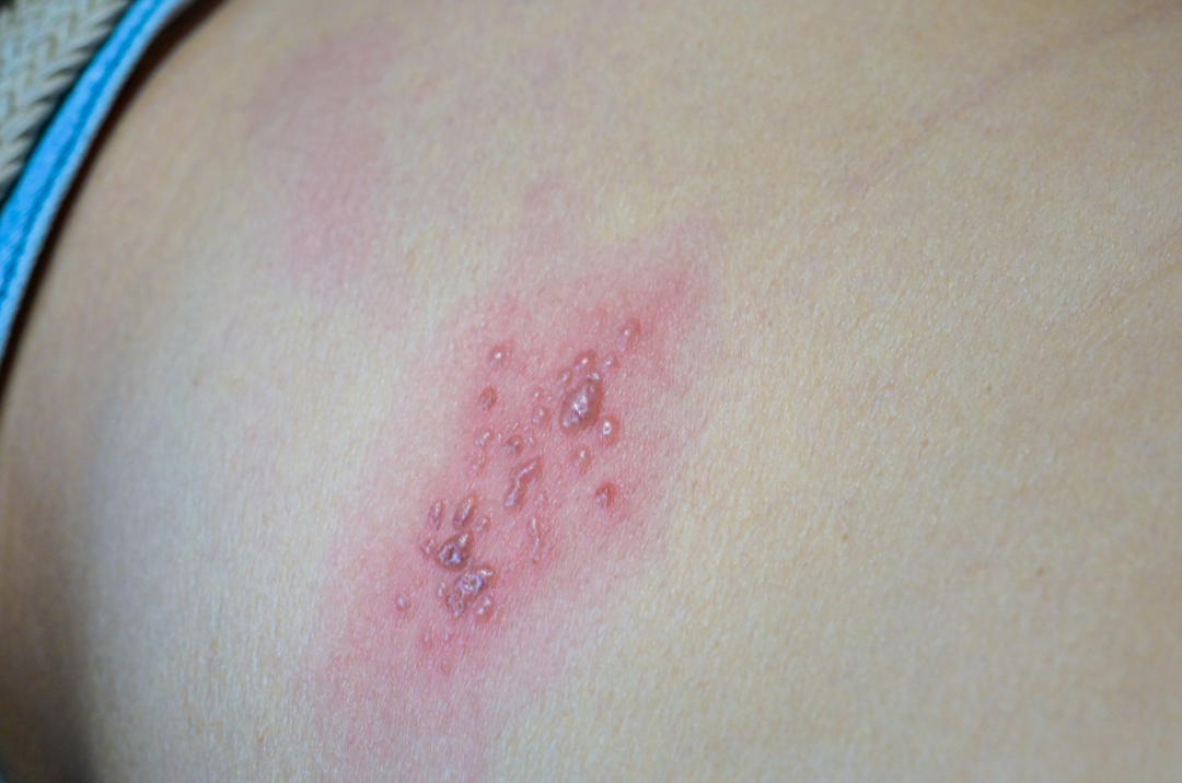 瘙痒的水疱只知道汗疱疹?还有这几种病也有可能|水疱_新浪财经_新浪网