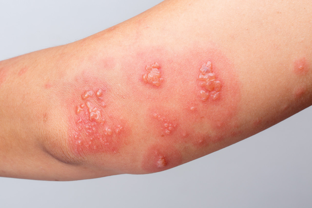 瘙痒的水疱只知道汗疱疹?还有这几种病也有可能