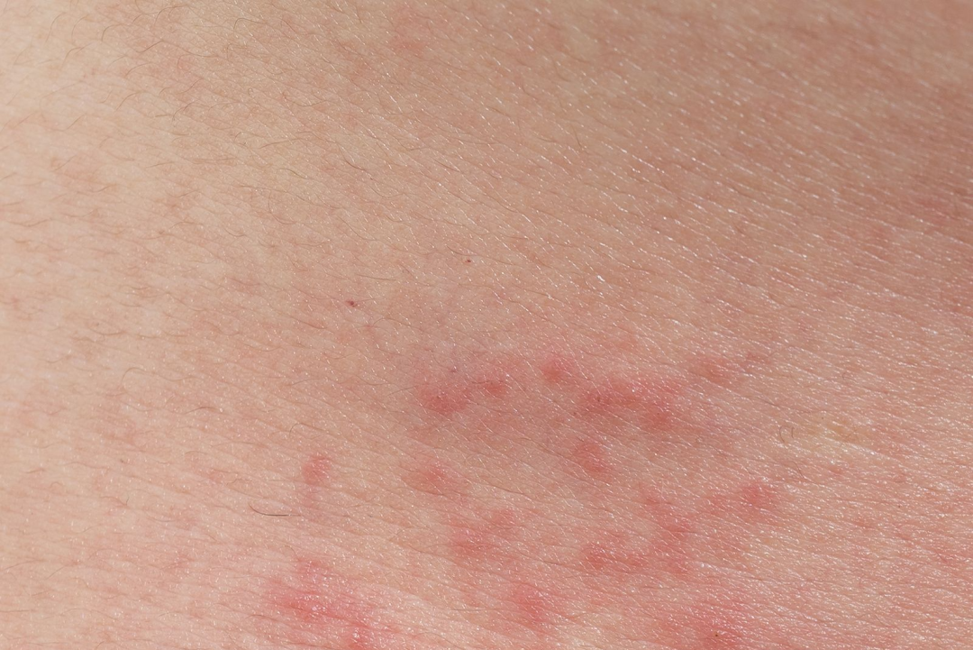 瘙痒的水疱只知道汗疱疹?还有这几种病也有可能|水疱_新浪财经_新浪网