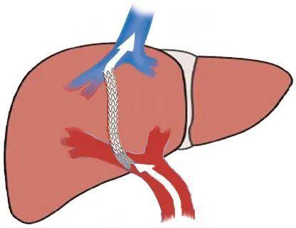 tips支架-"生命之桥"示意图tips手术是目前介入治疗中技术含量最高