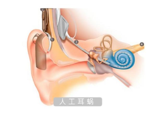 听力筛查仪器怎么看科技助听，共享美好生活——听力诊断和辅助器械介绍_https://www.jmylbn.com_新闻资讯_第5张