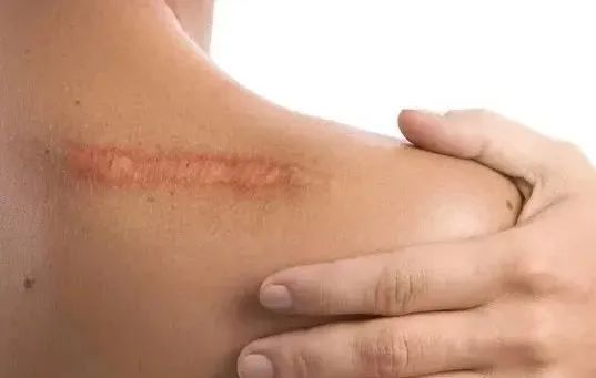 抓住 1 个黄金期,新老疤痕都管用|祛疤_新浪财经_新浪网