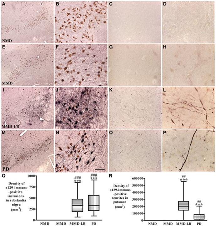 brain|新的研究挑战了对帕金森病的传统认识|突触_新浪财经_新浪网