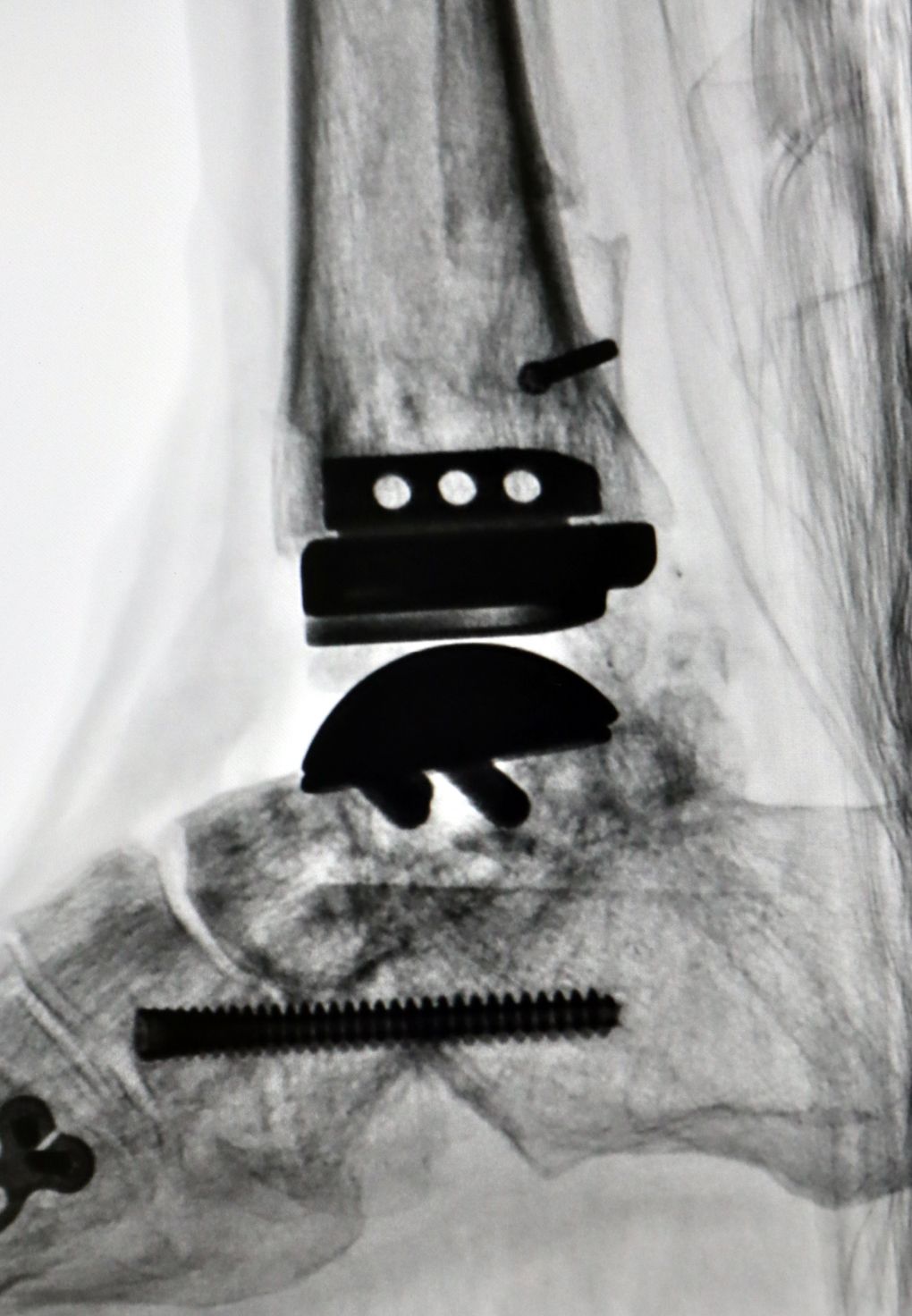 重建置换术让踝关节焕发新生