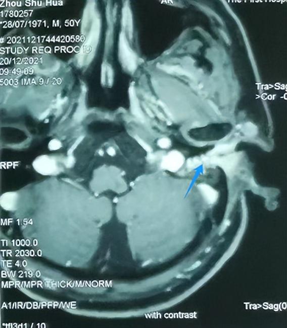 男子经常掏耳朵,10年后竟长出了癌|外耳道_新浪财经_新浪网