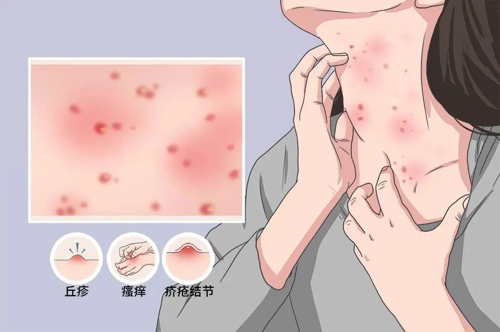 全家瘙痒,心存"疥"备|皮肤病_新浪财经_新浪网