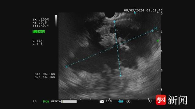 急性胰腺炎反复发作折磨8年!超声内镜新技术解决坏死难题