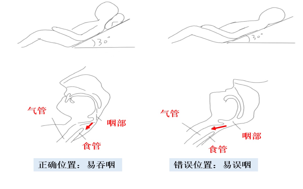 如图所示,我们可以看到,抬高床头垫枕后,后咽壁与会厌之间间隙减小