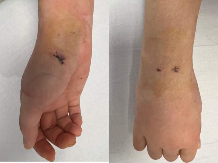 21岁女大学生手腕骨折!