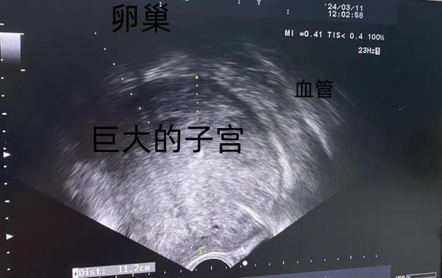 子宫内膜b超图图片