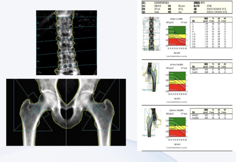 你知道超声骨密度检查和双能x线骨密度检查有什么不同吗