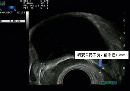 血精是因为前列腺炎吗?"真凶"原来是它_新浪财经_新浪网