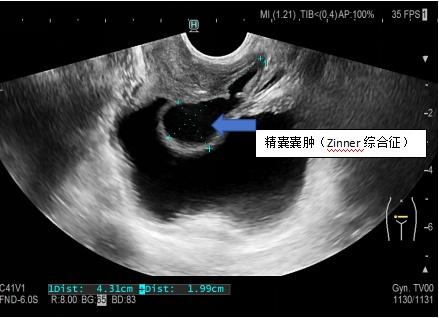 血精是因为前列腺炎吗?"真凶"原来是它