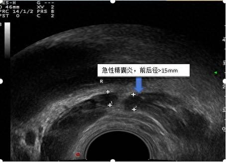 血精是因为前列腺炎吗?"真凶"原来是它