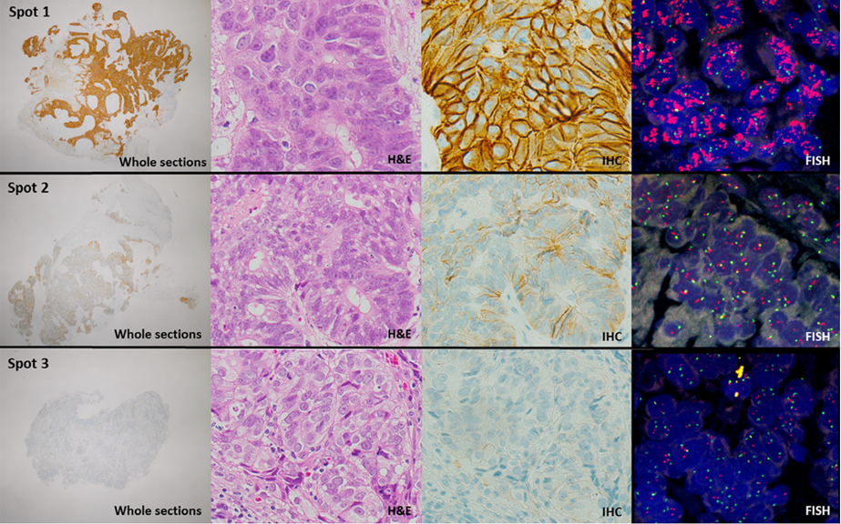 her2检测异质性处理与解读(乳腺癌与胃癌篇)|基因_新浪财经_新浪网