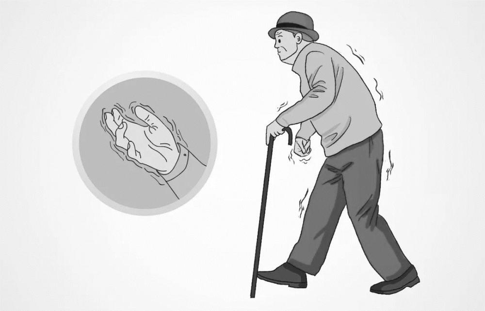 知"帕"抗"帕" 让生命不再颤|帕金森病_新浪财经_新浪网