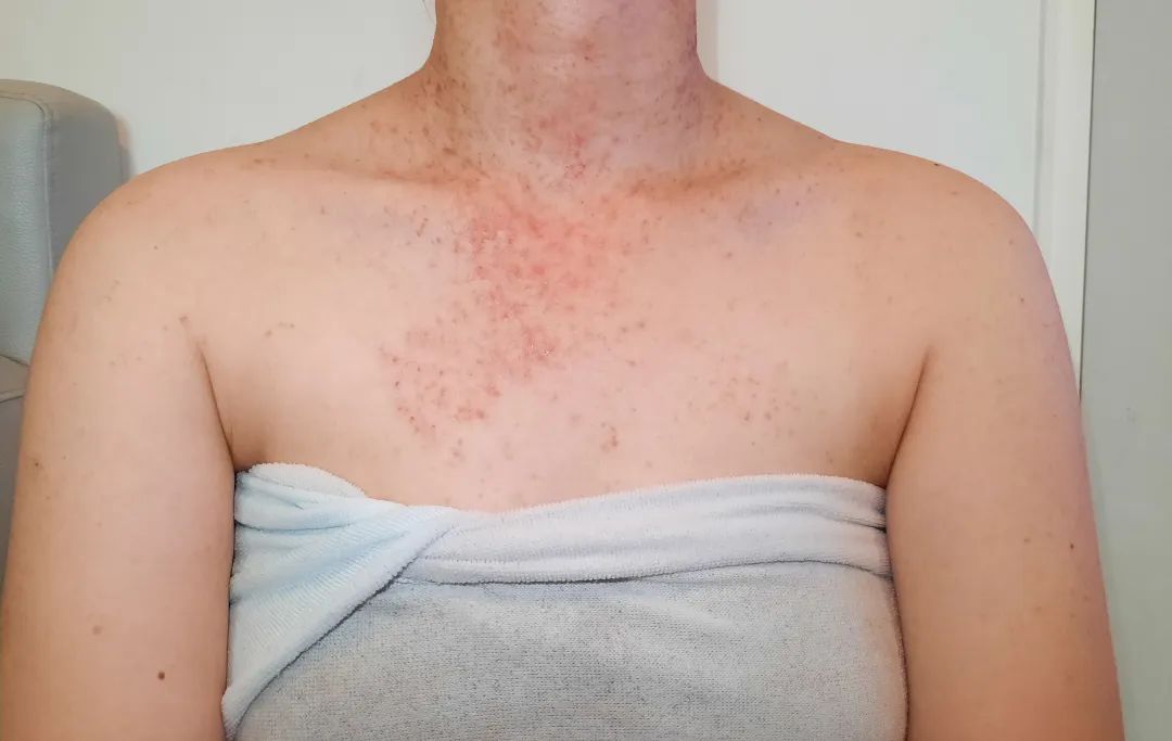 其多发生于胸背部,表现为胸背部痘痘样的皮疹,但与常见的感染性毛囊炎