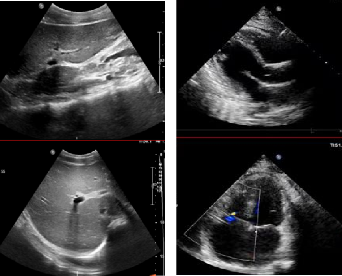 02诊治简介1,入院诊断1.酒精性肝硬化失代偿期;2.低蛋白血症;3.