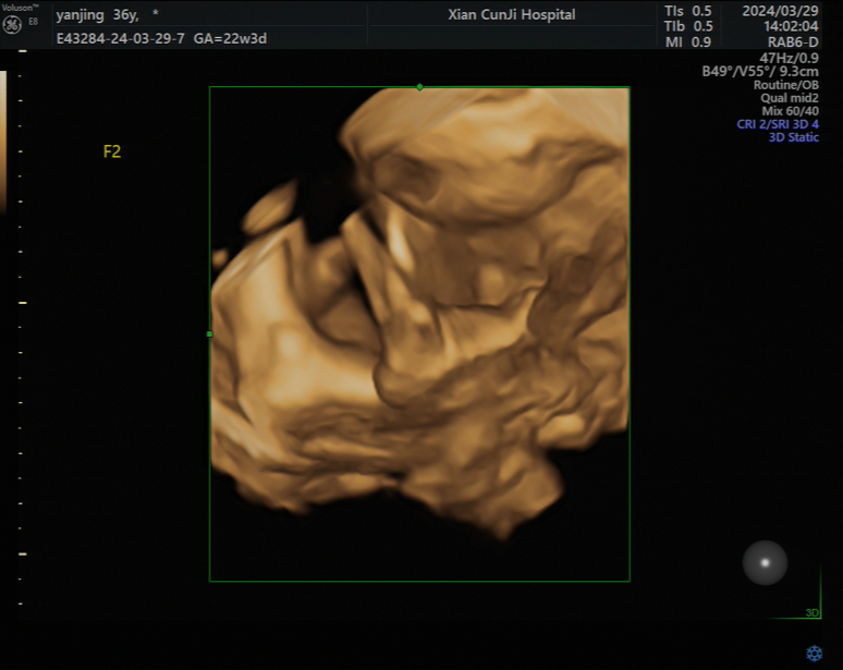 坐诊后,和家人专程前来,由黄侃主任和王文红医生为闫女士做四维彩超