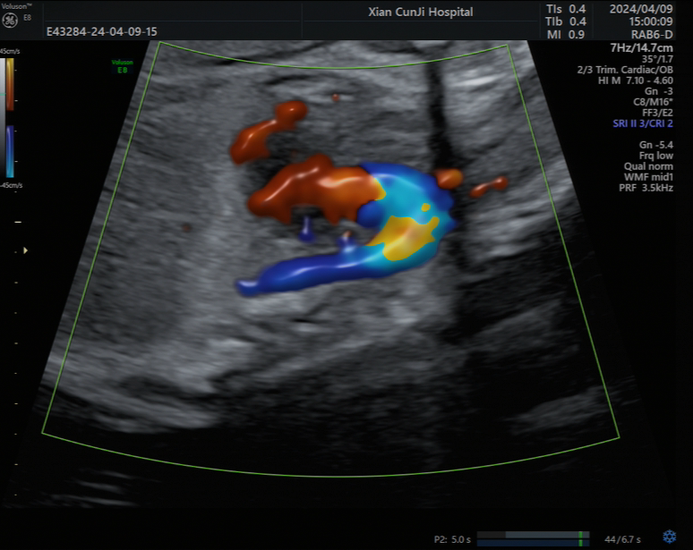 怀孕六周的胎儿b超图图片