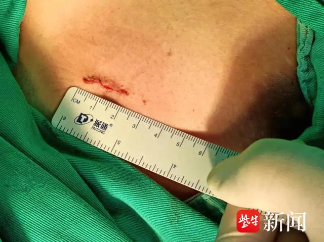 小伙子运动后,肺被压缩了三分之一|手术_新浪财经_新浪网