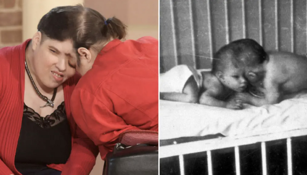 "世上最年长连体双胞胎"去世,终年62岁 一人健康,一人残疾|保罗·乔治