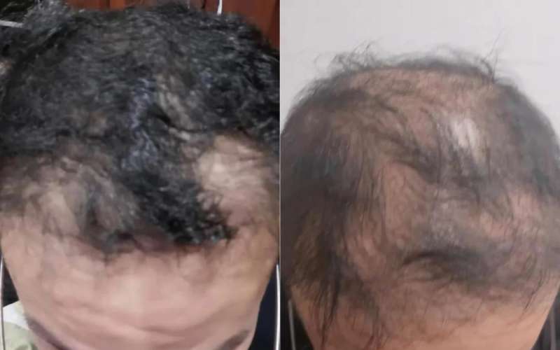 ▲消费者进行植发手术前后的头顶头发对比，左图拍摄于2022年1月初植发手术前，右图拍摄于2023年10月。新京报资料图