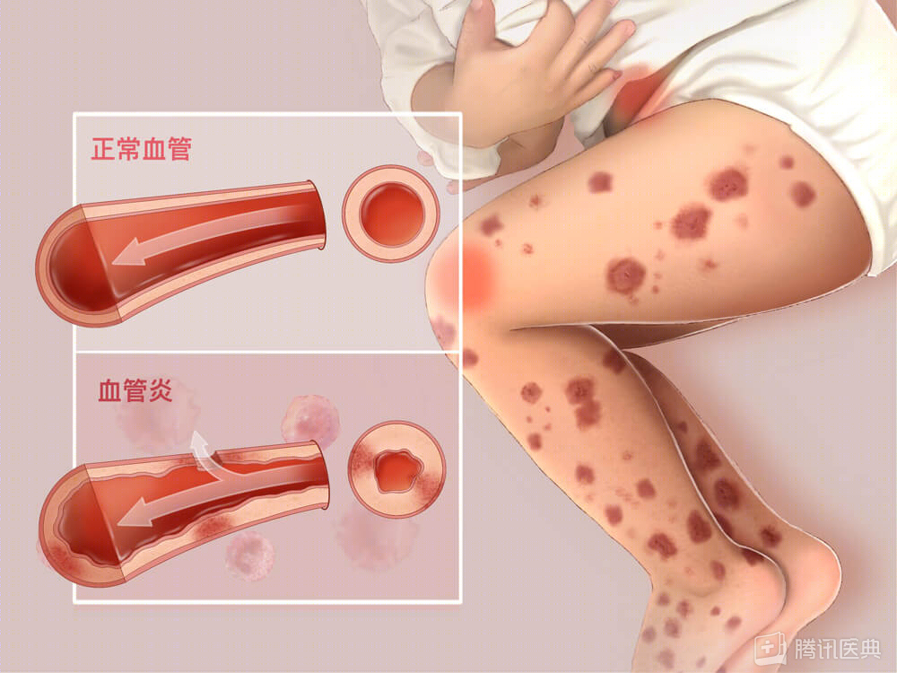 身上长了这 4 种小红点,要抓紧看医生