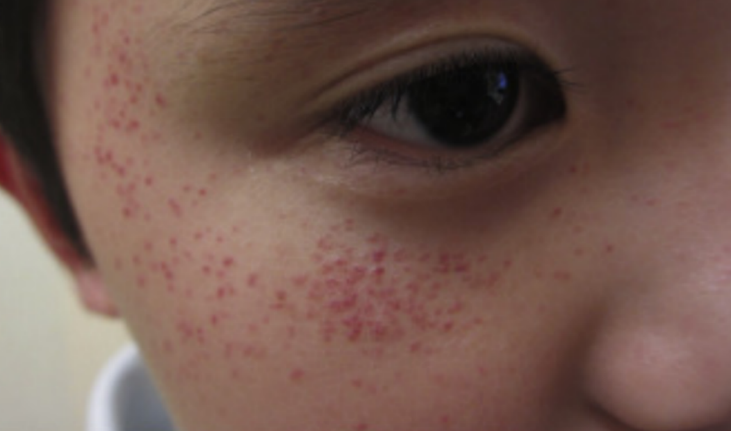 看了这么多,想必大家对血管痣有了更深的认识了吧?