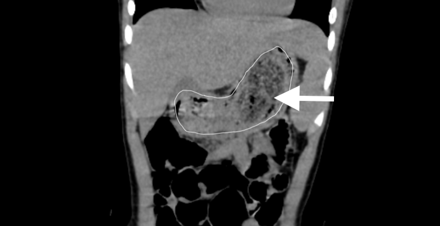 CT检查呈现明明胃内有巨大的毛发石