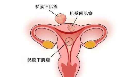 科普|总是不怀孕,原来是子宫肌瘤惹的祸?