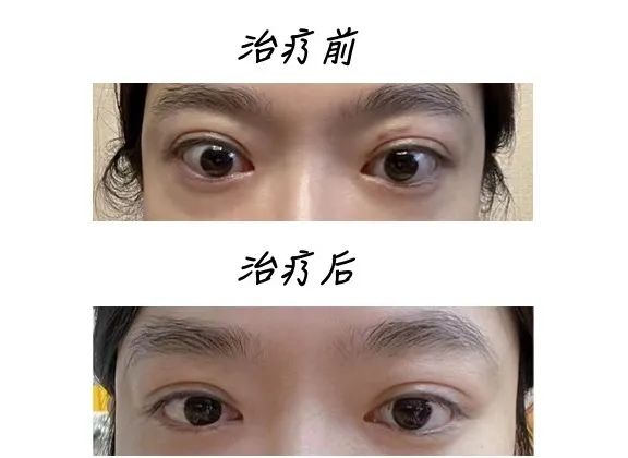 甲亢引起的眼突,可以恢复吗?