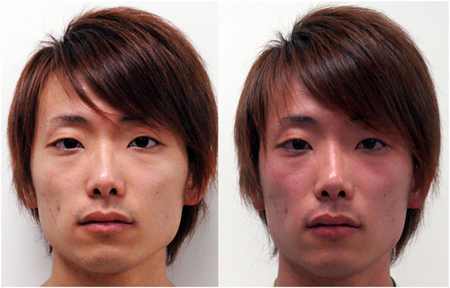 图片来源：文献，典型的亚洲脸红综合征