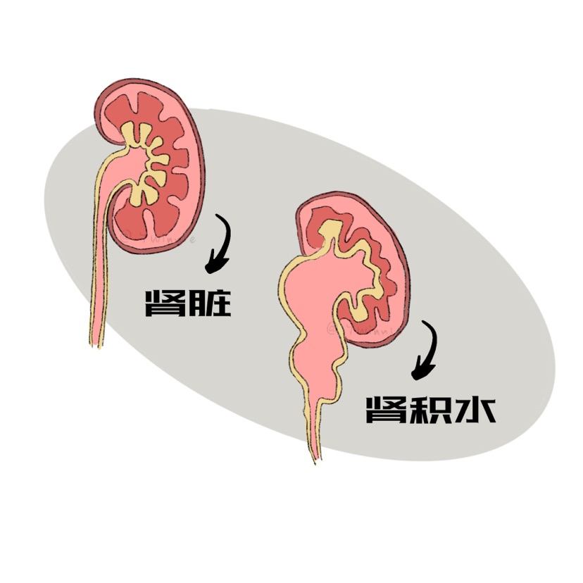 尿路结石不可大意!